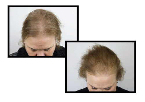 follicle stimulation before and after